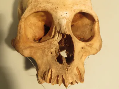 The cranium of an adult male, likely 25 to 30 years old, shows healed trauma affecting the upper jaw. The injury was probably caused by a punch from another individual in a fight.